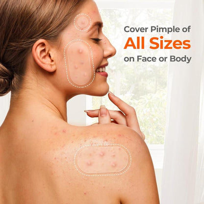 Kepory - Pimple Patches