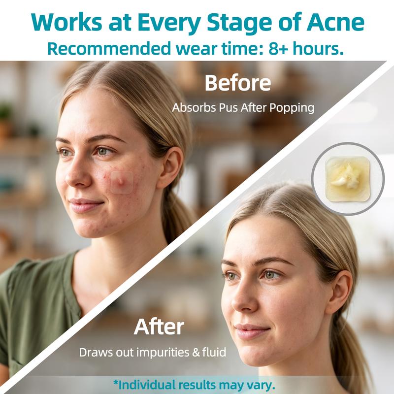 Dimora Medical-Grade Hydrocolloid Acne Patch Roll