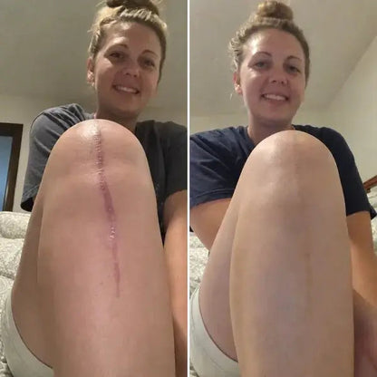 Kepory -Scar Removal Cream